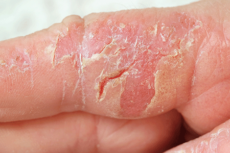 Eczéma de contact dermatite atopique cause main traitement naturel sans ...